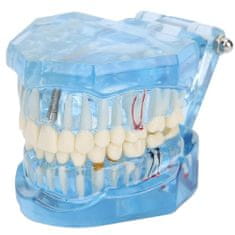 Verk 01964_N Model zubných implantátov modrá
