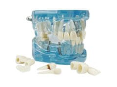 Sobex Zubný model čeľuste zuby zubné implantáty